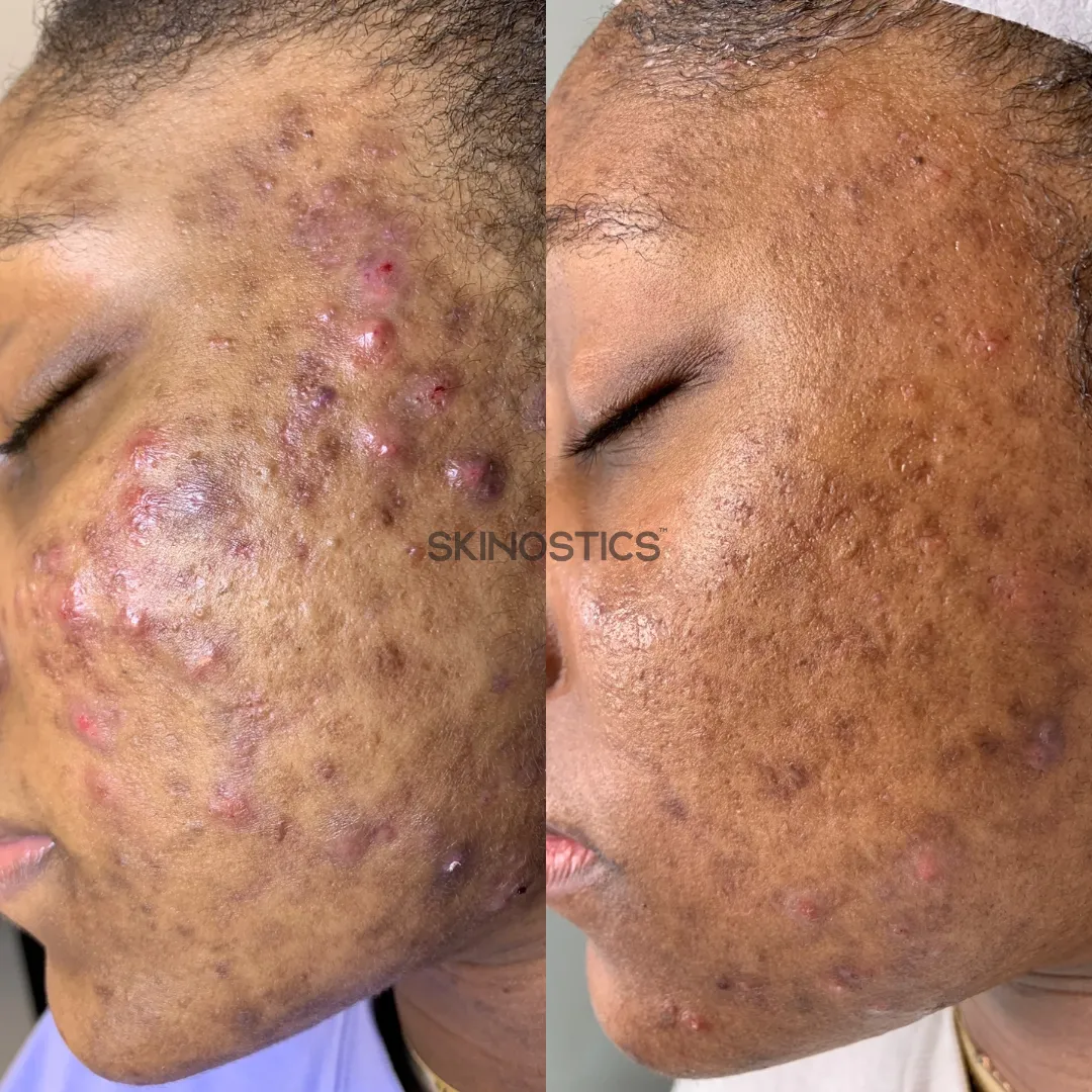 Acne Transformation