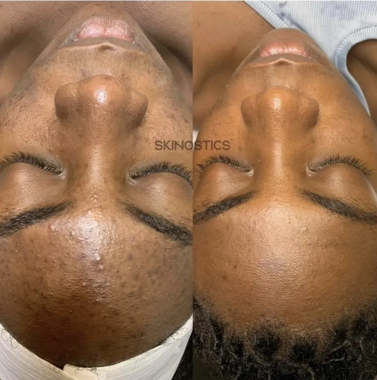 Hyperpigmentation Transformation